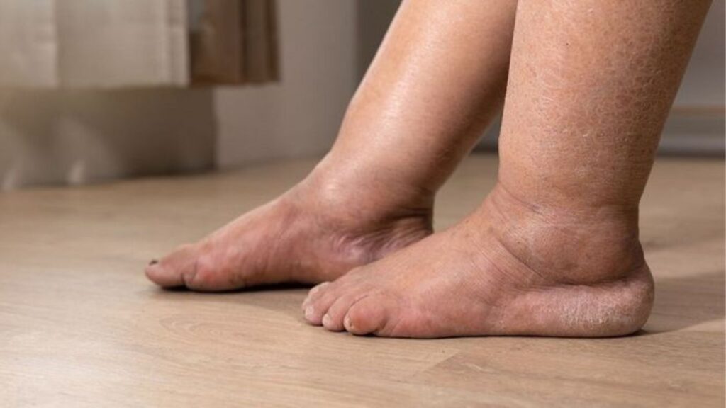Lipedema: a doença que afeta milhões de mulheres e ainda é confundida com obesidade 1 Lipedema 1